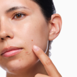 The Acne Set-Regular - Image 2